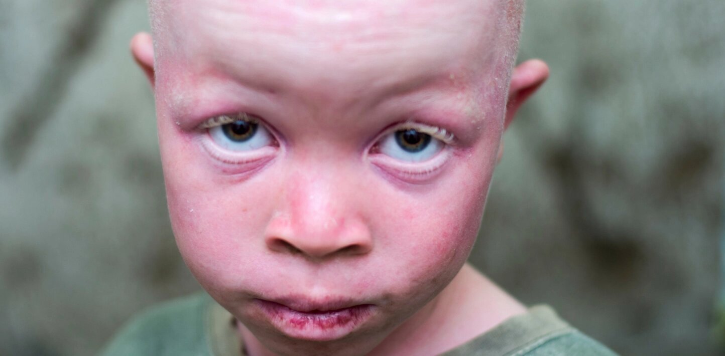 228214_violence-and-discrimination-against-people-with-albinism-in-malawi-2-scaled-1444x710 (1)